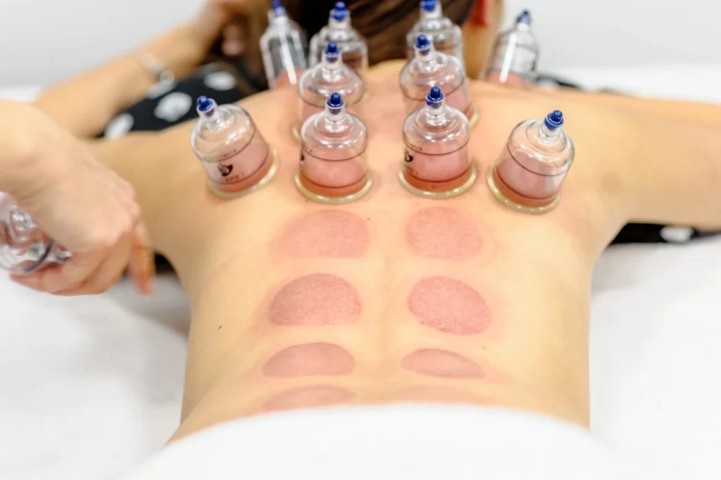 cupping masaža